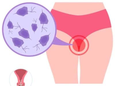 Vaginal Infections: Types, Symptoms, and Causes Every Woman Should Know